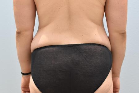 Before image 3 Case #124426 - Tummy Tuck