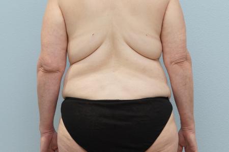Before image 3 Case #124276 - Mommy Makeover