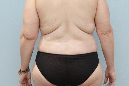 After image 3 Case #124276 - Mommy Makeover