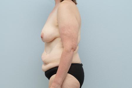 Before image 2 Case #124276 - Mommy Makeover
