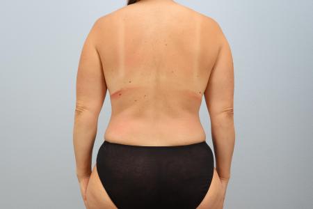 After image 3 Case #125811 - Comprehensive Mommy Makeover | Dr. Neaman