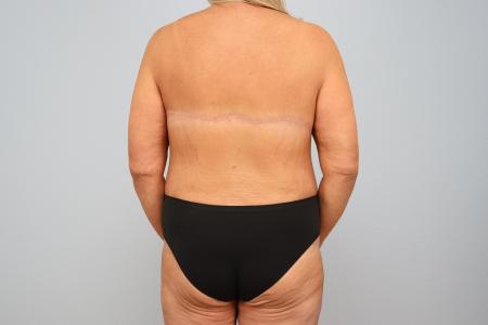 After image 3 Case #125516 - Mommy Makeover for 47-Year-Old Patient | Dr. Neama