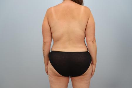 After Case #126031 - Mommy Makeover by Dr. Neaman After Case #126031 - Mommy Makeover by Dr. Neaman