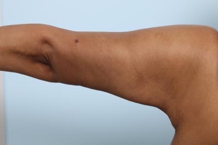After image 2 Case #125941 - Arm Lift After image 2 Case #125941 - Arm Lift