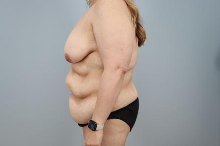 Before image 2 Case #125516 - Mommy Makeover for 47-Year-Old Patient | Dr. Neama