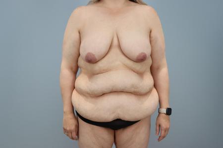 Before image 1 Case #125516 - Mommy Makeover for 47-Year-Old Patient | Dr. Neama