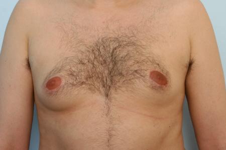 Before image 1 Case #125996 - Gynecomastia