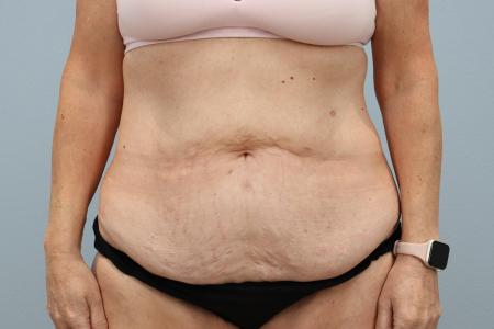 Before image 1 Case #125556 - Tummy Tuck & Liposuction Results | Dr. Neaman