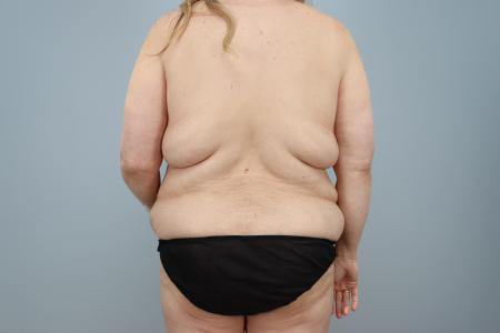 Before image 3 Case #125516 - Mommy Makeover for 47-Year-Old Patient | Dr. Neama