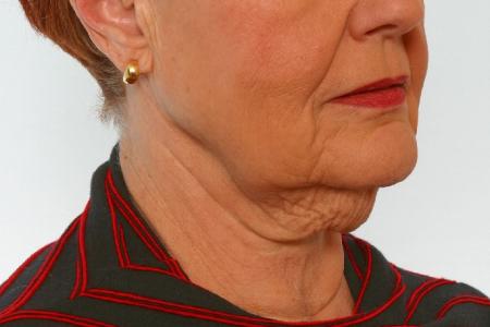 Before image 2 Case #125916 - Neck Lift