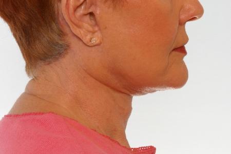 After image 3 Case #125916 - Neck Lift
