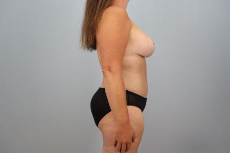 After Case #126031 - Mommy Makeover by Dr. Neaman After Case #126031 - Mommy Makeover by Dr. Neaman