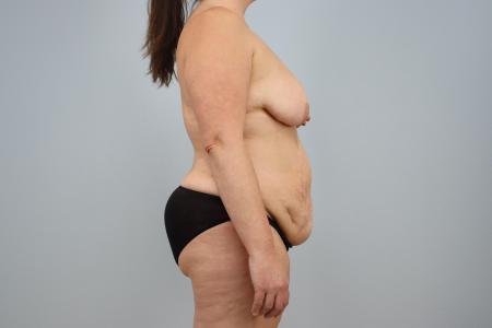 Before Case #126031 - Mommy Makeover by Dr. Neaman Before Case #126031 - Mommy Makeover by Dr. Neaman