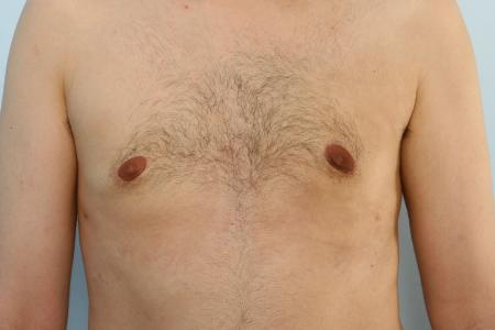 After image 1 Case #125996 - Gynecomastia