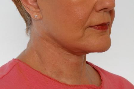 After image 2 Case #125916 - Neck Lift