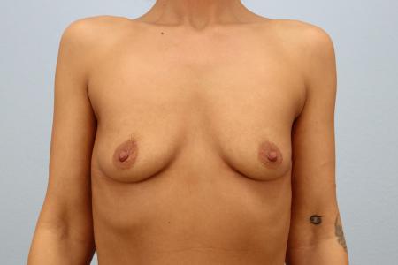 Before image 1 Case #125521 - 560cc Silicone Breast Augmentation | 6-Month Resul