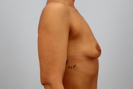 Before image 3 Case #125521 - 560cc Silicone Breast Augmentation | 6-Month Resul