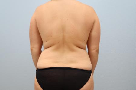 Before image 3 Case #125811 - Comprehensive Mommy Makeover | Dr. Neaman