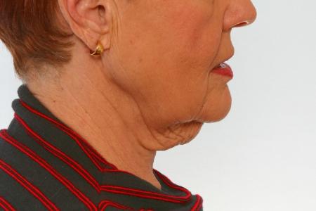 Before image 3 Case #125916 - Neck Lift