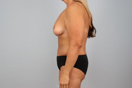 After image 2 Case #125516 - Mommy Makeover for 47-Year-Old Patient | Dr. Neama