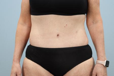 After image 1 Case #125556 - Tummy Tuck & Liposuction Results | Dr. Neaman