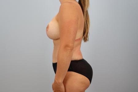After image 2 Case #125811 - Comprehensive Mommy Makeover | Dr. Neaman