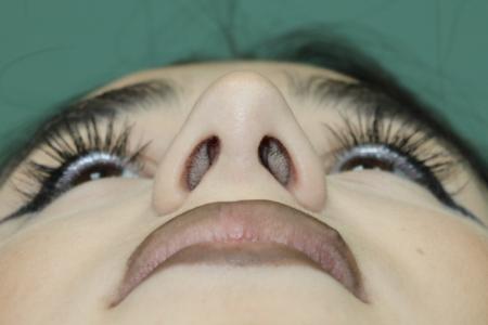 After image 6 Case #126786 - Nasal Deviation Syndrome