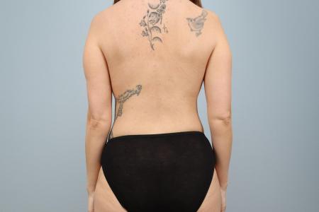 After image 3 Case #126196 - Tummy Tuck with Breast Enhancement | Salem Oregon