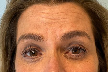 Before image 1 Case #126216 - 54 year old woman treated with Botox