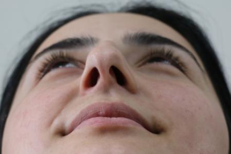 Before image 6 Case #122581 - Primary Rhinoplasty