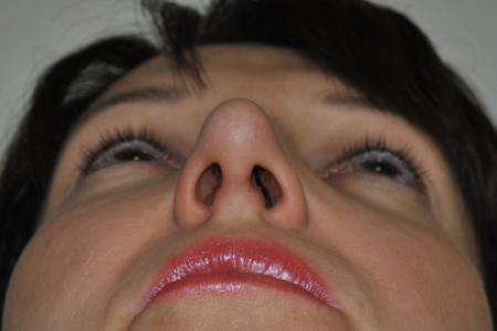 After image 6 Case #126781 - Aesthetic Reduction Rhinoplasty