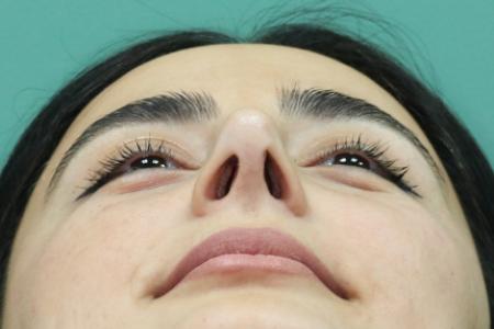 After image 6 Case #122581 - Primary Rhinoplasty