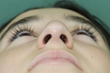 Before image 6 Case #126786 - Nasal Deviation Syndrome