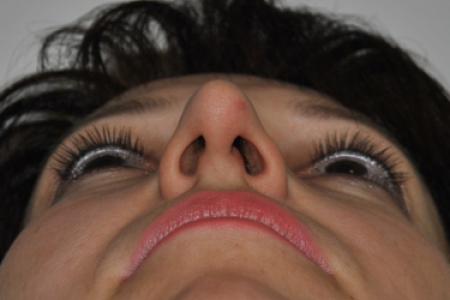 Before image 6 Case #126781 - Aesthetic Reduction Rhinoplasty