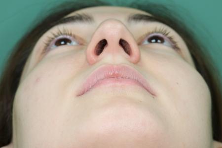 Before image 6 Case #126811 - Reduction Rhinoplasty