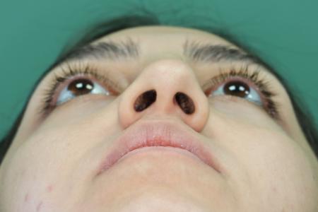 Before image 6 Case #126796 - Nasal Deviation Syndrome. Rhinogenic Headache 