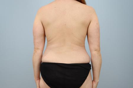 Before image 3 Case #126711 -  Mommy Makeover | Oregon Body Contouring