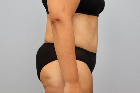 After image 2 Case #126181 - Tummy Tuck and Bra Line Back Lift Results by Dr. N