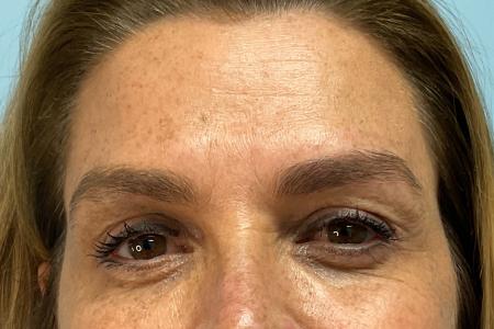 After image 1 Case #126216 - 54 year old woman treated with Botox