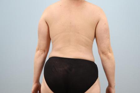 After image 3 Case #126711 -  Mommy Makeover | Oregon Body Contouring