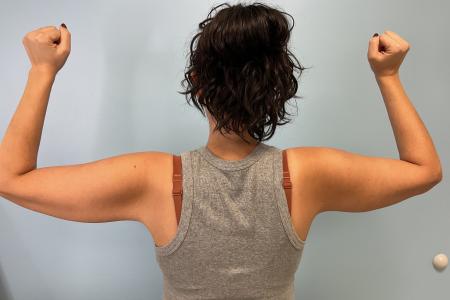 After image 1 Case #127231 - 39 y.o. Female w/ Bilateral Brachioplasty and Lipo