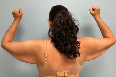 Before image 1 Case #127231 - 39 y.o. Female w/ Bilateral Brachioplasty and Lipo