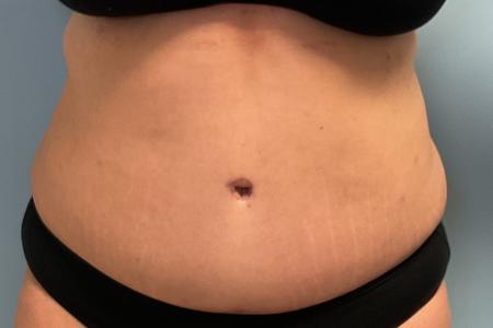 After image 1 Case #127386 - 35 y.o. female w/ Tummy Tuck & Lipo of flanks 