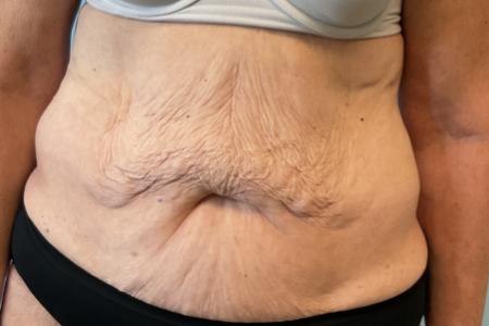 Before image 1 Case #127556 - Tummy Tuck + Lipo of Flanks/Thighs + Bra Line Lift