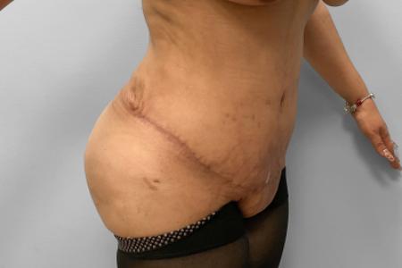 After image 2 Case #127691 - Mommy Makeover