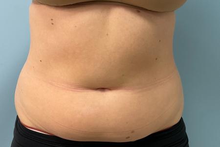 Before image 1 Case #127931 - 30 y.o. female w/ Lipo of abs, flanks w/ Renuvion