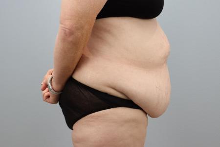 Before image 2 Case #127941 - Tummy Tuck Before and After – 60-Year-Old Female