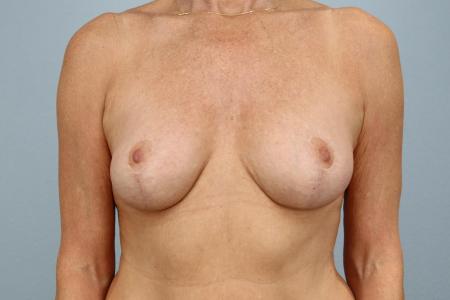 After image 1 Case #128306 - Natural Breast Lift Results After Weight Changes