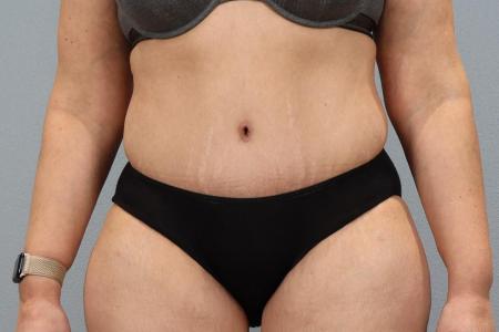 After image 1 Case #128291 - Tummy Tuck 6 months post-op | Salem, OR