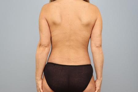 After image 3 Case #127951 - Mommy Makeover Body Contouring Transformation